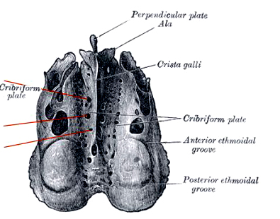 cribriform plate fracture