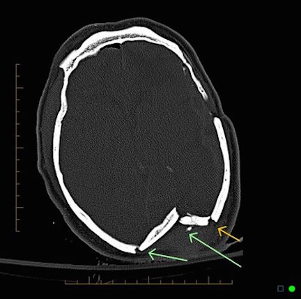 basilar fracture symptoms