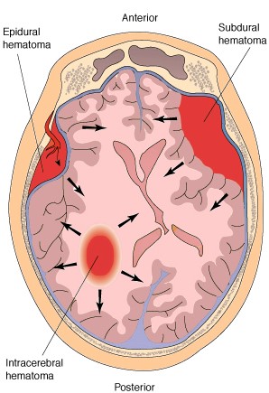 Hematoma.