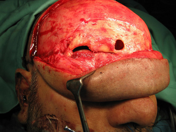 gunshot wound to head. hole or a gunshot wound.