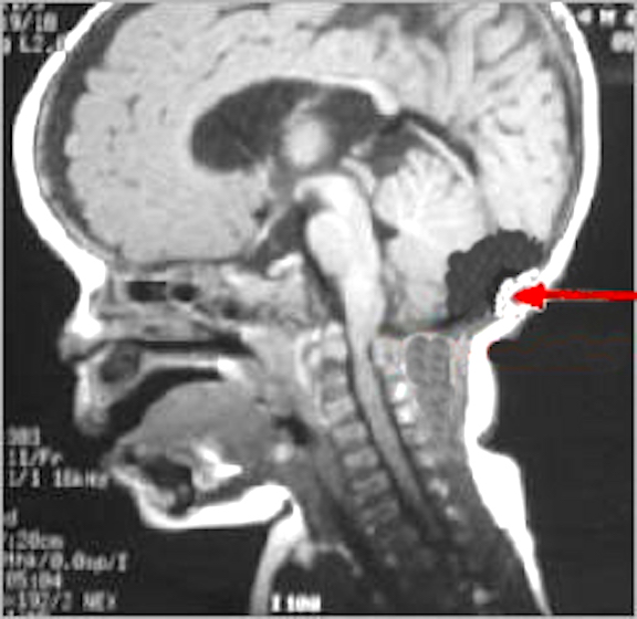 basilar fracture