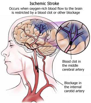Brain Infarction